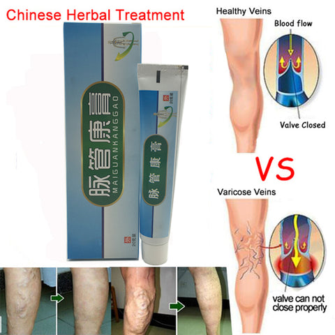 Medical Varicose Veins Treatment Leg Acid Bilges Itching Earthworm Lumps Old Bad Leg Vasculitis Cream Chinese Medicine